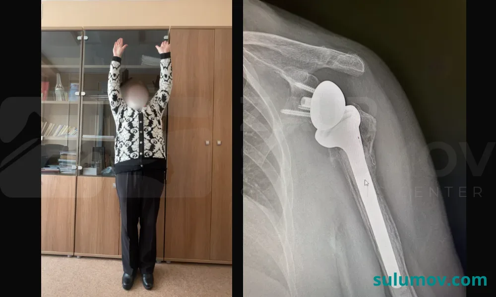 Эндопротезирование плечевого сустава
