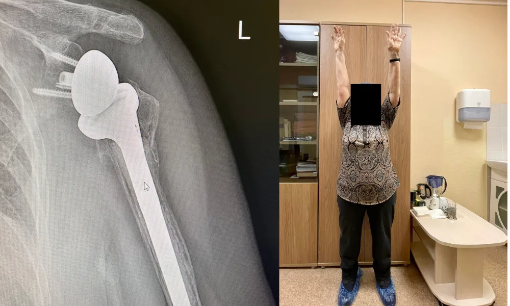 Shoulder Replacement