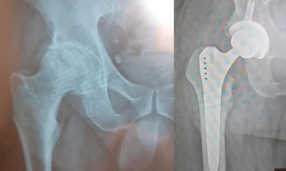 Hip Replacement