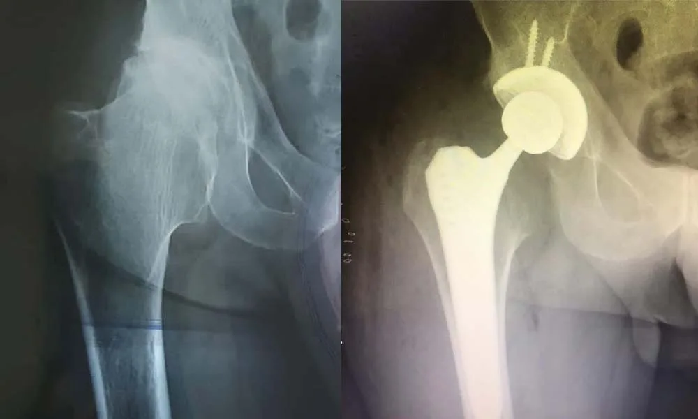 Hip Replacement