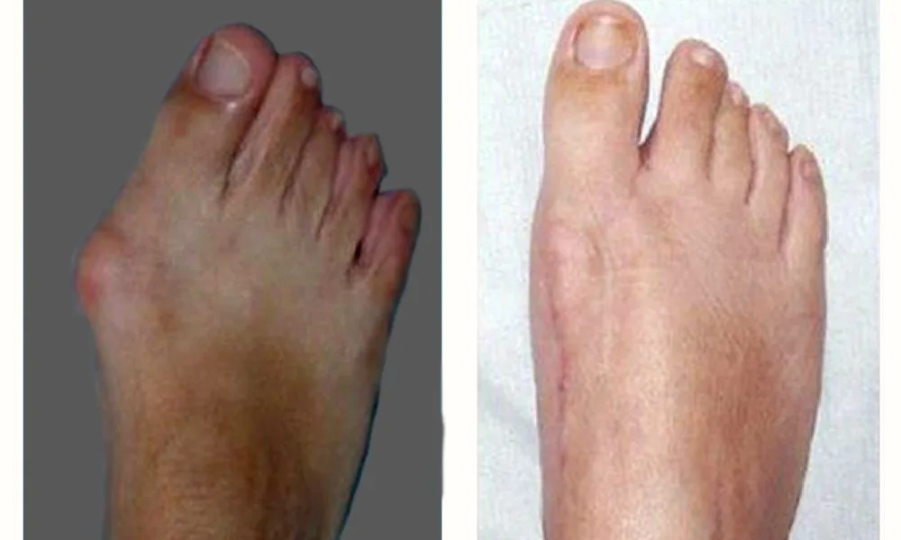 Foot Deformity Correction