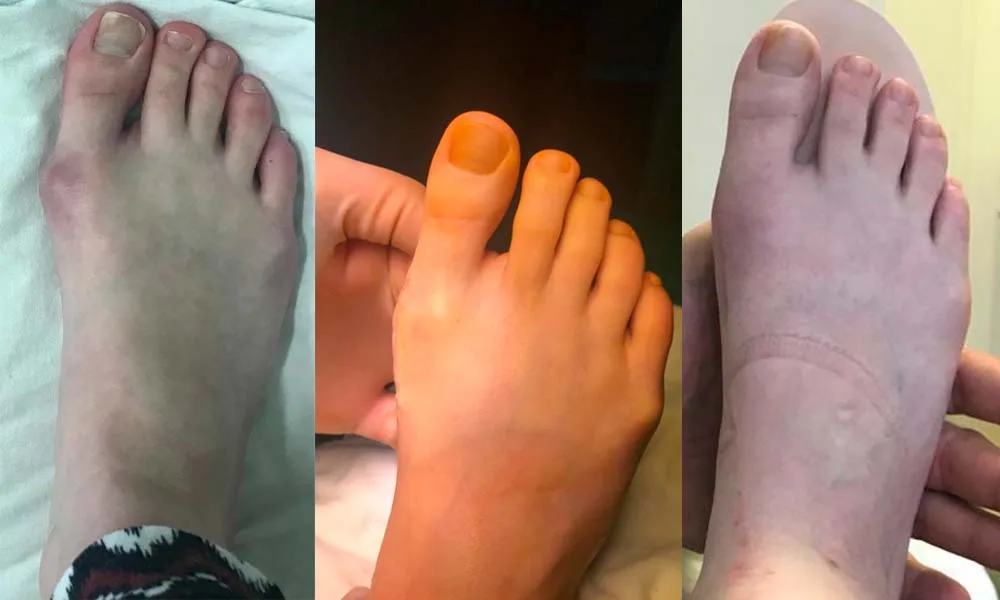 Foot Deformity Correction