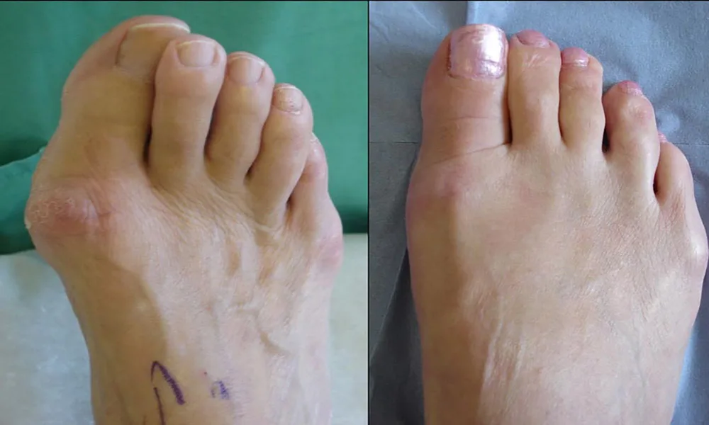 Foot Deformity Correction