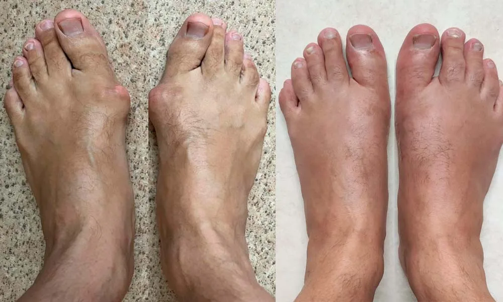 Foot Deformity Correction