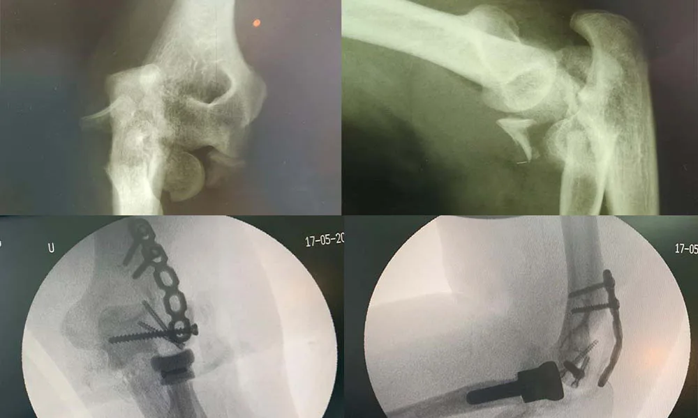 Osteosynthesis for Fractures