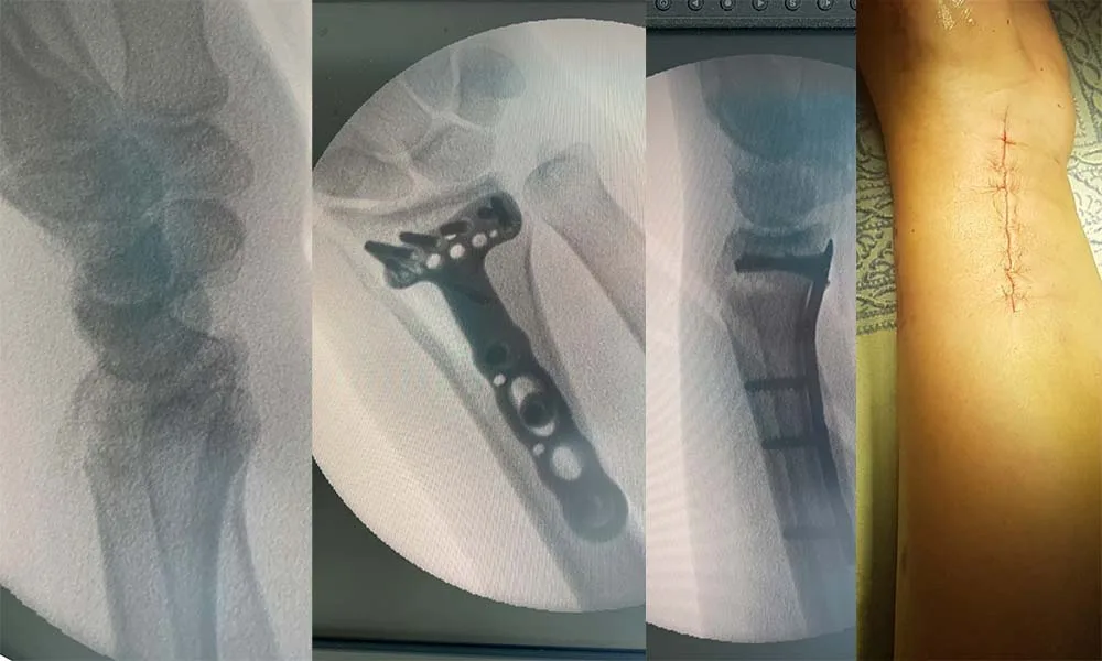Osteosynthesis for Fractures