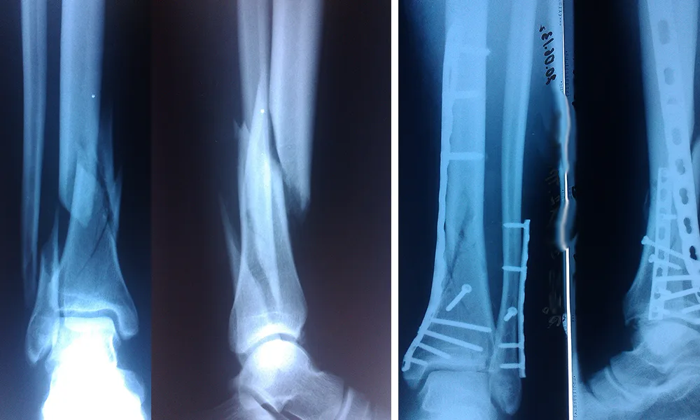 Osteosynthesis for Fractures