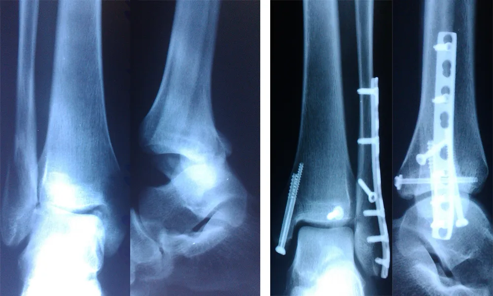 Osteosynthesis for Fractures