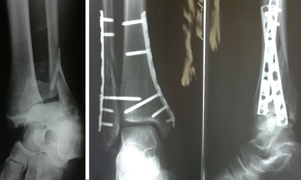 Osteosynthesis for Fractures