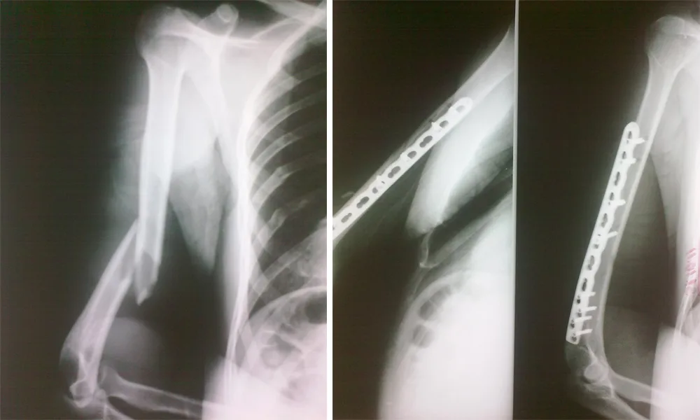 Osteosynthesis for Fractures