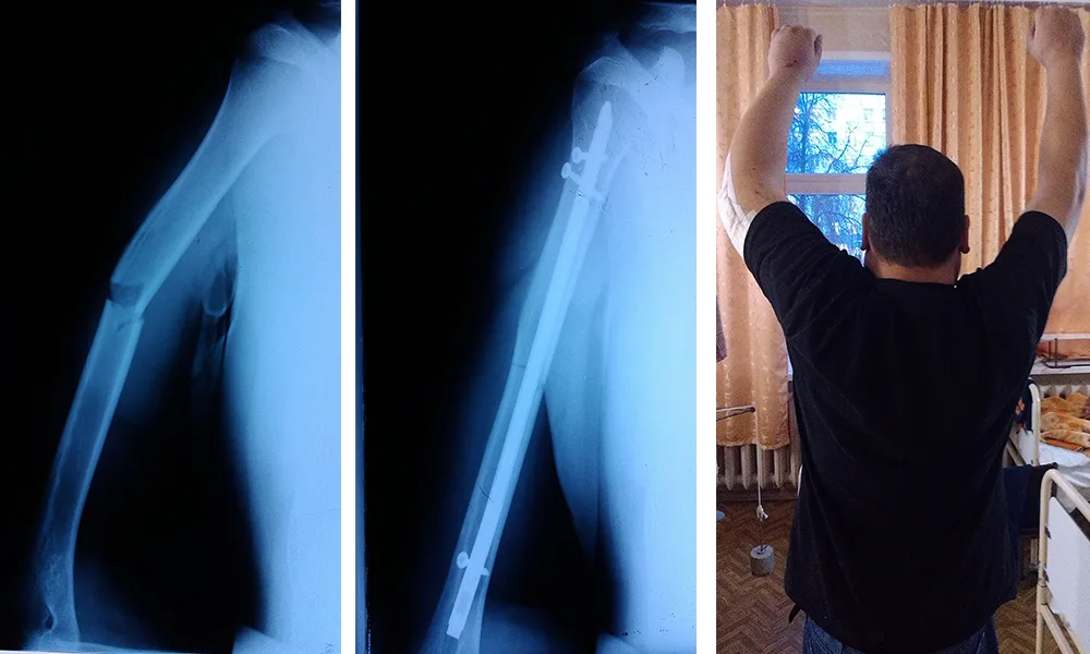 Osteosynthesis for Fractures