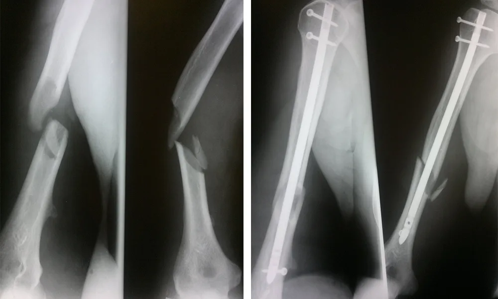 Osteosynthesis for Fractures
