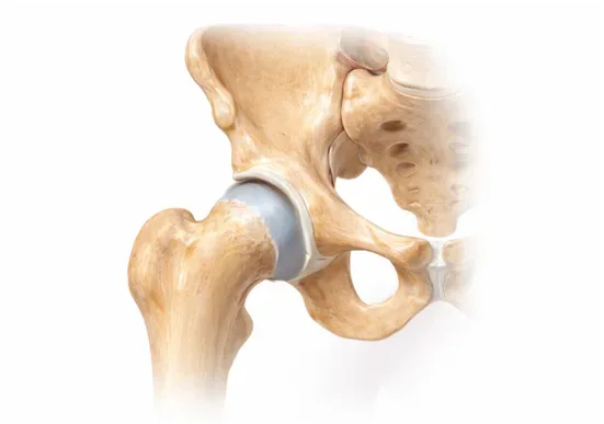Hip replacement surgery