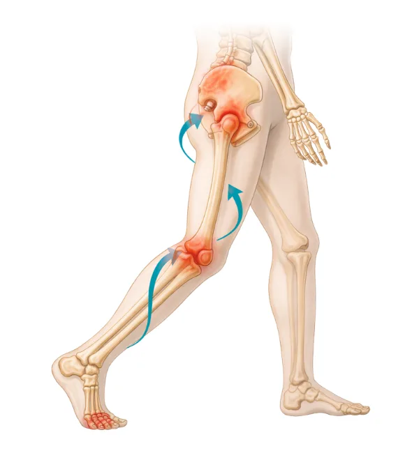 How Foot Deformities Affect Gait and the Joints Above