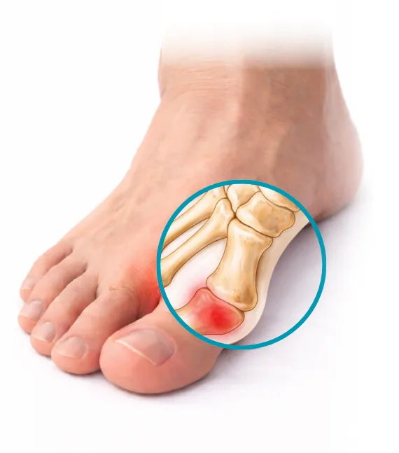When Surgical Correction of Foot Deformities Is Truly Indicated