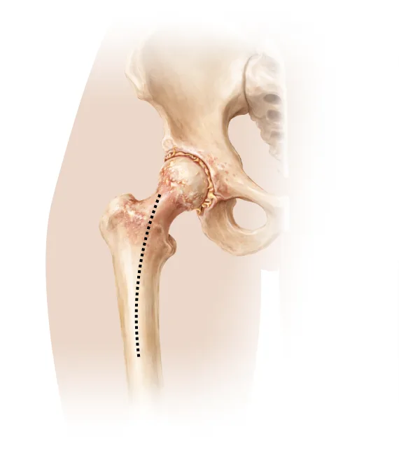 Minimally invasive anterolateral intermuscular Röttinger approach