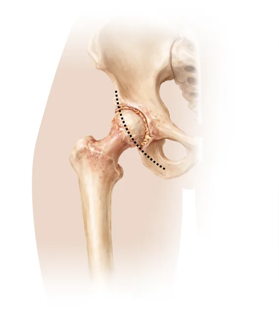Minimally Invasive Joint Replacement (Anterior Approach)