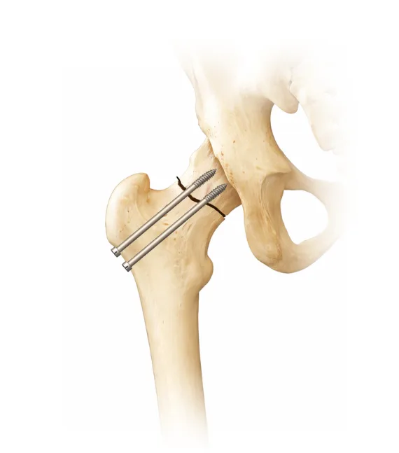 Femoral neck fracture