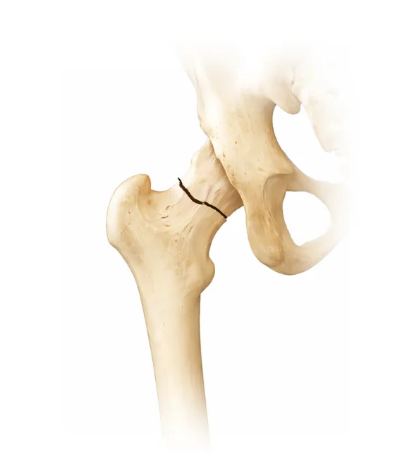 Clinical features of a femoral neck fracture