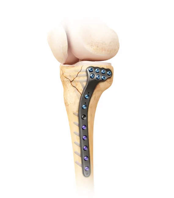 Tibial fracture