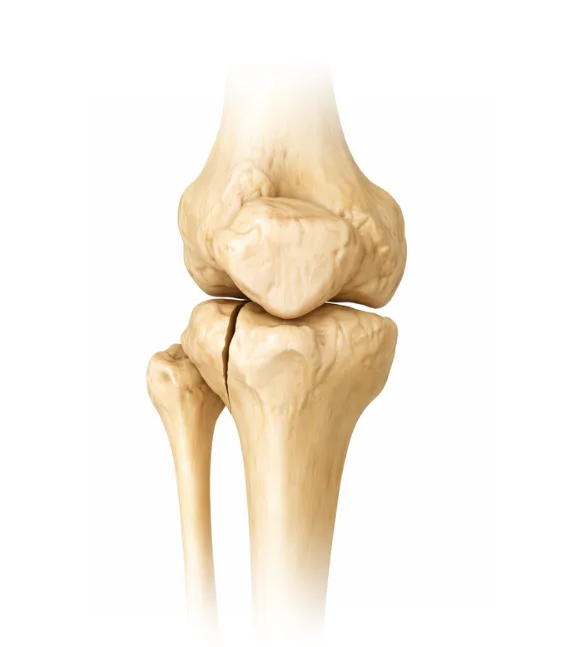 What determines the treatment strategy for a tibial fracture