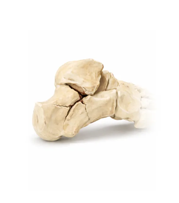 Features of a calcaneal fracture and their impact on walking