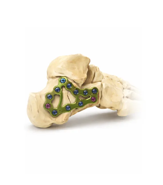 Calcaneal fracture