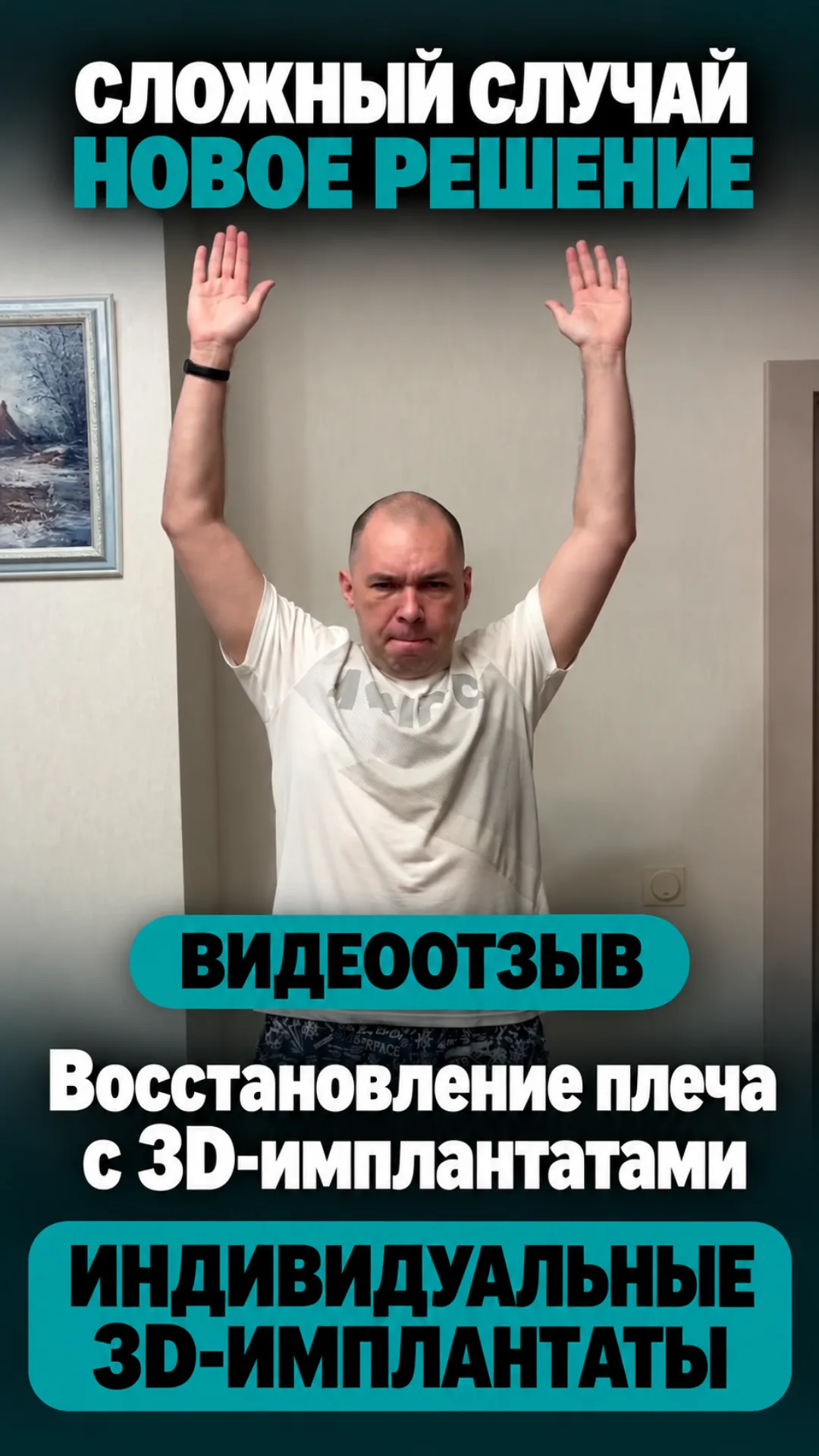 Восстановление плечевого сустава с помощью индивидуальных 3D-имплантатов