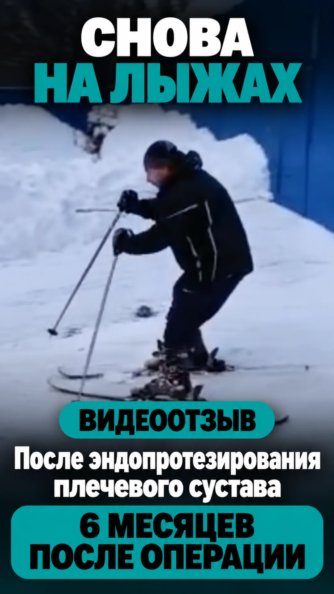 Полгода после эндопротезирования плечевого сустава.