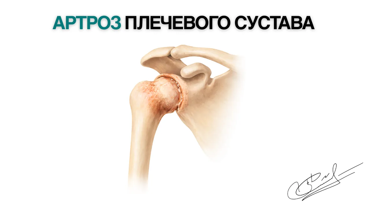 Артроз плечевого сустава: причины боли и современные методы лечения