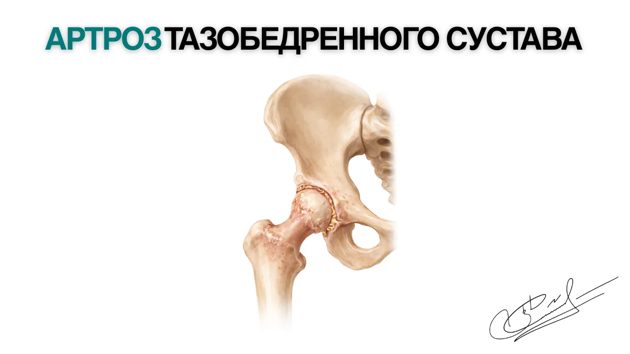 Артроз тазобедренного сустава: как развивается заболевание и какие есть варианты лечения