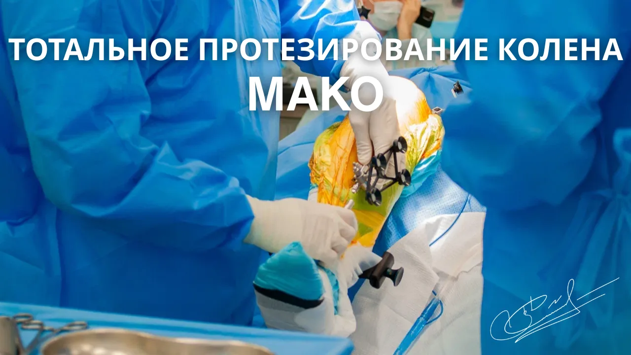 Тотальное эндопротезирование коленного сустава с роботом Мако