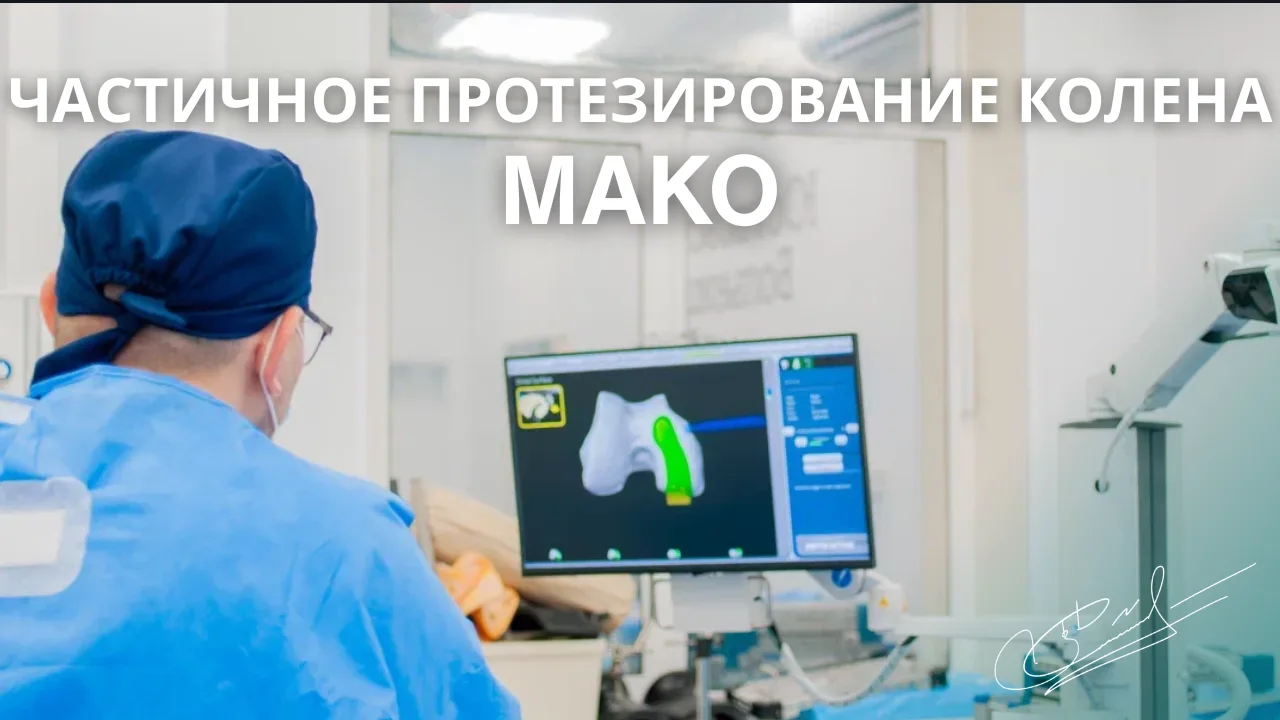 Робот Мако при одномыщелковом эндопротезировании коленного сустава