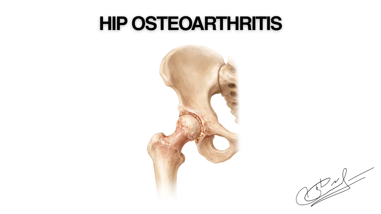 Hip osteoarthritis: how the condition develops and what treatment options are available