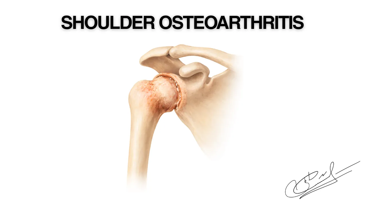 Shoulder osteoarthritis: causes of pain and modern treatment options