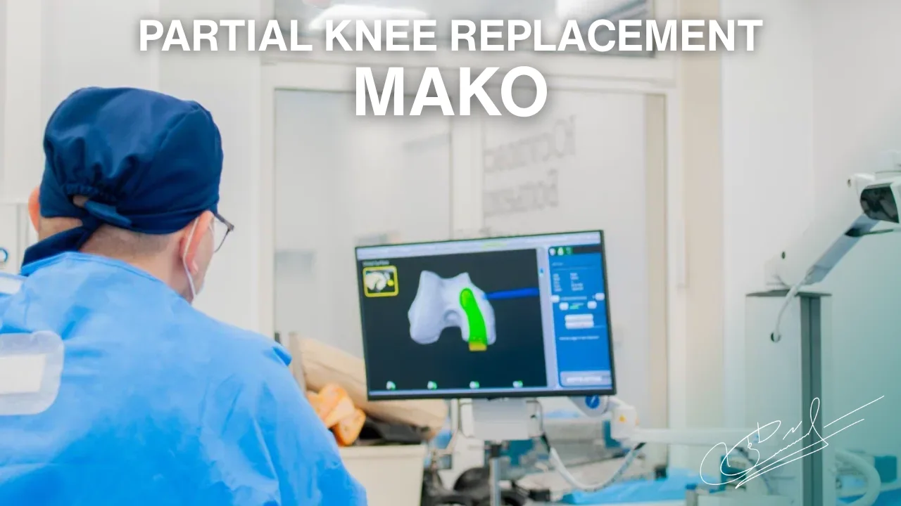 Mako Robot in Unicompartmental Knee Replacement